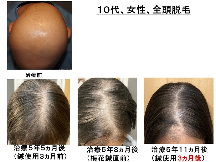 円形脱毛症　病院